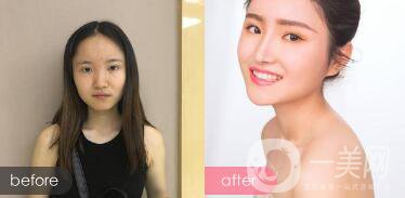 蒜頭鼻整形圖片 蒜頭鼻整形多少錢？