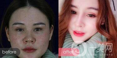 注射隆鼻整形多少要錢？微整形注射隆鼻過程