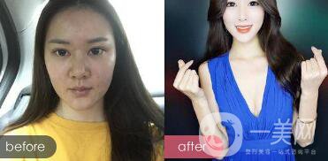 注射隆鼻整形多少要錢？微整形注射隆鼻過程