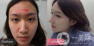 歪鼻整形痛嗎？歪鼻矯正圖片