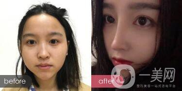 歪鼻整形痛嗎？歪鼻矯正圖片