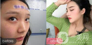 駝峰鼻整形的費(fèi)用 駝峰鼻型的女人命運(yùn)