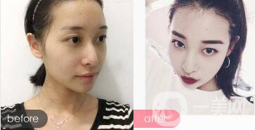 駝峰鼻整形的費(fèi)用 駝峰鼻型的女人命運(yùn)