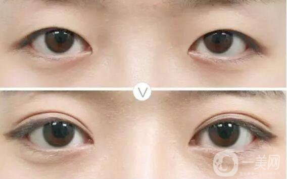蘇李秀英醫(yī)院,割雙眼皮多少錢