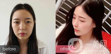 成都綜合隆鼻多少錢？綜合隆鼻真人案例