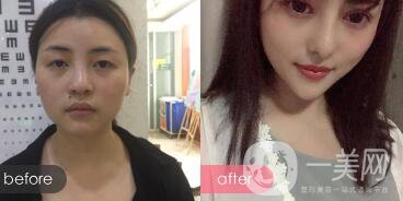 成都綜合隆鼻多少錢？綜合隆鼻真人案例