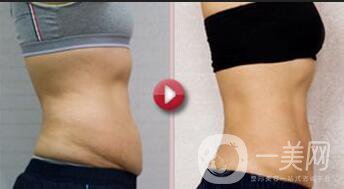 腹壁整形手術(shù)多少錢