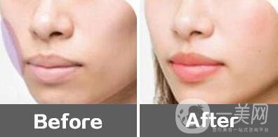 注射玻尿酸豐面頰,優(yōu)勢