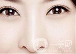 駝峰鼻整容,矯正駝峰鼻方法,駝峰鼻整容注意事項(xiàng)