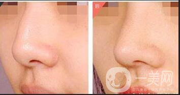 駝峰鼻整容,矯正駝峰鼻方法,駝峰鼻整容注意事項(xiàng)