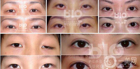 北京雙眼皮修復(fù)