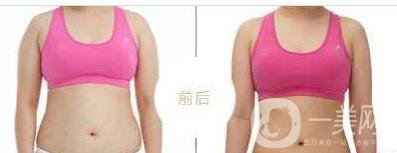 吸脂術(shù)不能做的事有哪些 什么是激光和超聲輔助吸脂術(shù)