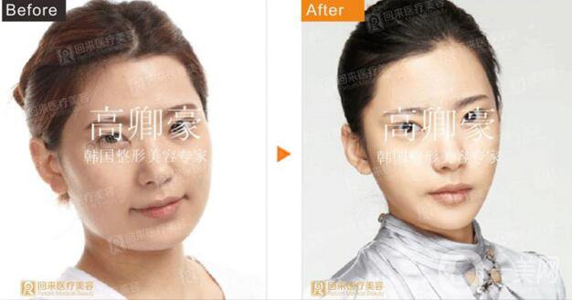 深圳回來醫(yī)療面部輪廓案例
