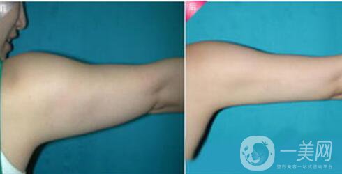 吸脂后皮膚會(huì)松弛嗎