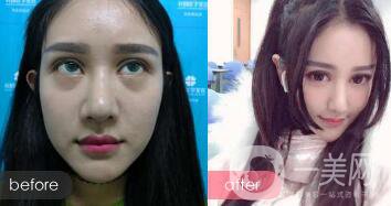 調(diào)節(jié)和預(yù)防黑眼圈