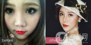 *手術(shù)恢復(fù)多久？多久可以拆線？