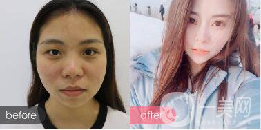 *手術(shù)恢復(fù)多久？多久可以拆線？