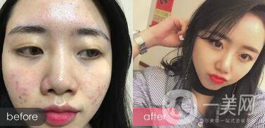 果酸祛痘*果嗎 果酸祛痘有什么好處？