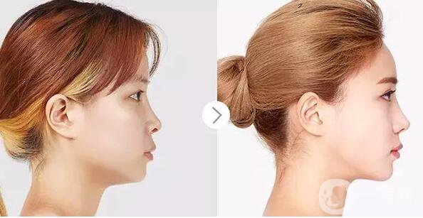 硅膠隆鼻材料的優(yōu)勢有哪些