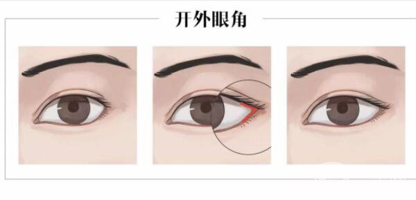 開外眼角前后圖片