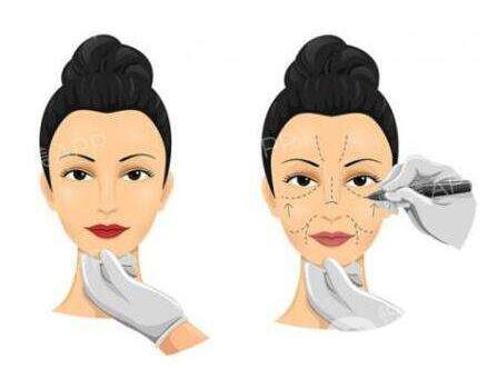 電波拉皮除皺術5年后*果還有嗎