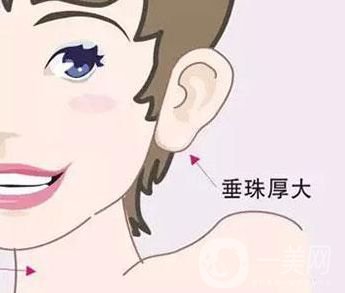 玻尿酸豐耳垂大約多少錢