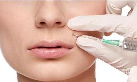 玻尿酸鼻唇溝