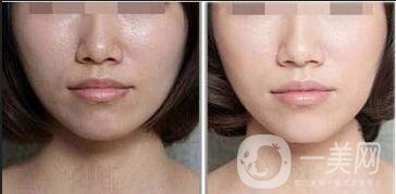 激光美白價(jià)格