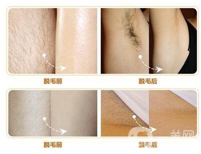 什么是激光脫毛？激光脫毛的優(yōu)勢有哪些？