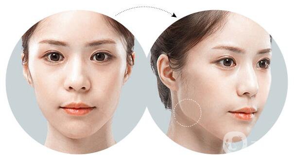 激光溶脂瘦臉好不好