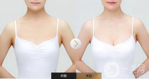 脂肪隆胸手術(shù)是一次就成型的嗎