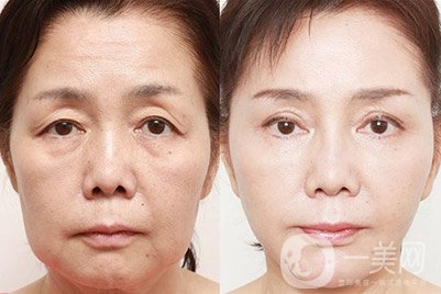 打膠原蛋白去皺針過(guò)程分析介紹