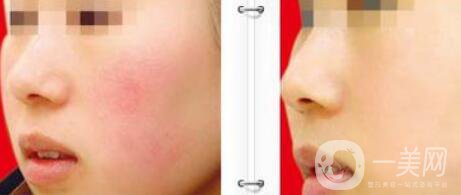 光子嫩膚*果,光子嫩膚禁忌癥