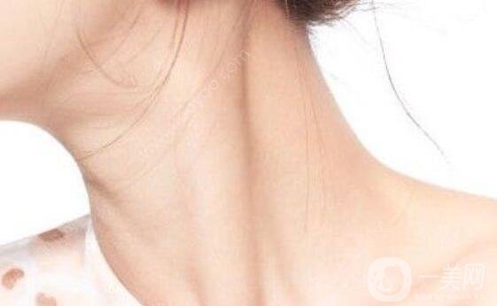 怎么消除頸紋