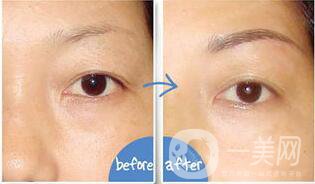 眉毛提升術(shù)