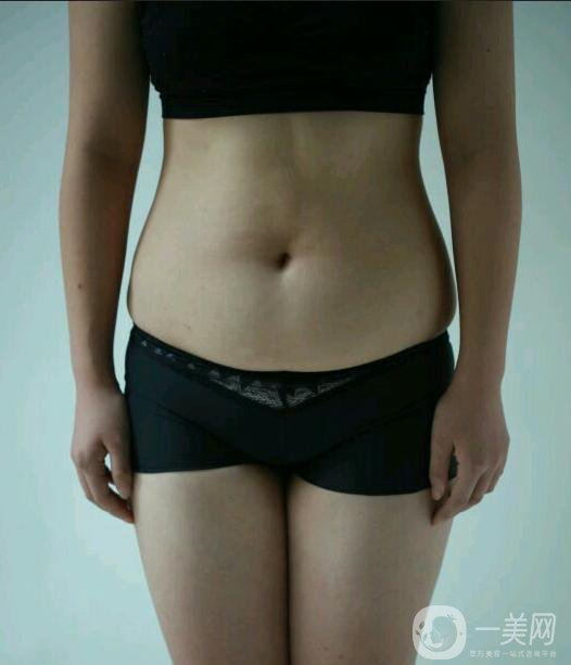 水動(dòng)力吸脂親身經(jīng)歷