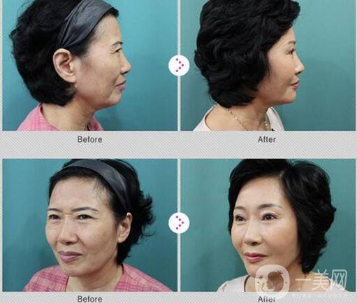 拉皮手術(shù)十年后的情況會是怎樣的