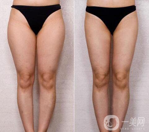 成都抽脂減肥價(jià)格是多少呢