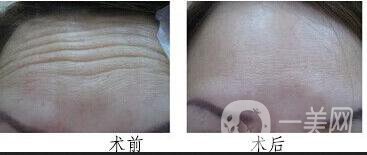 怎樣除去抬頭紋