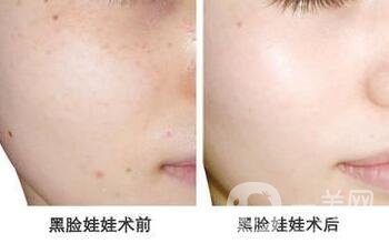 黑臉娃娃的作用