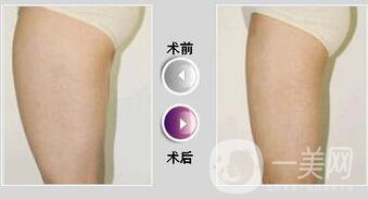 360度環(huán)形吸脂價(jià)格,360度環(huán)形吸脂*果