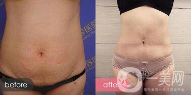 腹壁成形手術(shù)