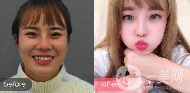 玻尿酸眼部除皺