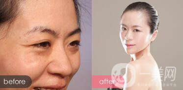 玻尿酸眼部除皺