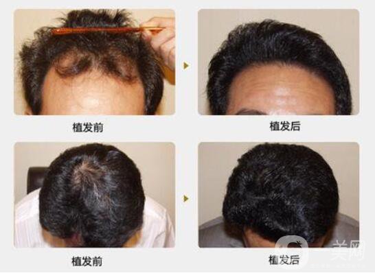 什么是植發(fā)手術(shù)？脫發(fā)的主要原因？