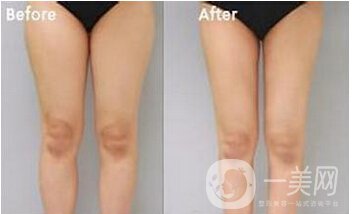 水動力溶脂減肥讓你度過性感的夏天