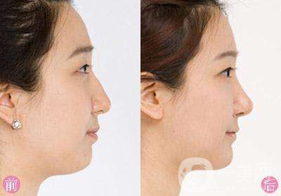 駝峰鼻整形后有后遺癥嗎 注意事項(xiàng)有哪些