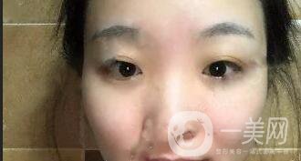 開(kāi)眼角價(jià)格