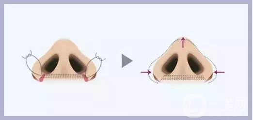 成都鼻翼縮小費(fèi)用是多少呢