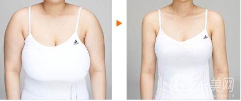 乳房縮小是為了什么呢 來聽聽專家的解說